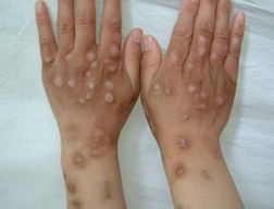 白癜風預防措施有哪些