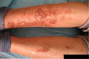 濕疹有什么特性