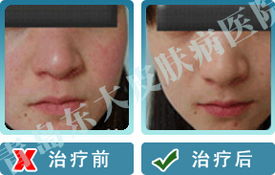 臨沂皮膚病醫院哪家好