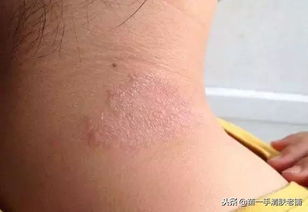 患了牛皮癬 吃這個食品,對牛皮癬的康復很有幫助