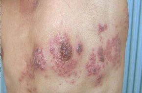 患過帶狀皰疹的人中風風險大