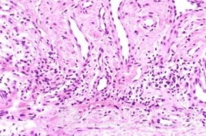 青島皮膚病研究院專家教你預防梅毒