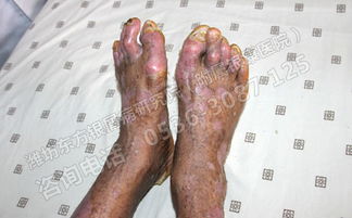 春季如何預(yù)防關(guān)節(jié)型銀屑病復(fù)發(fā)