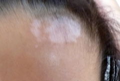 為治好孩子的白斑 我選青島皮膚病研究院