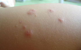 慢性蕁麻疹能治好嗎