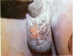 男性陰囊濕疹是由于不注意衛生導致的嗎