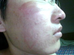 青島臉上紅腫癢怎么辦