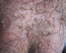 青島皮膚病研究院專家介紹患上虱病該怎么治療