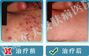 山東治療毛囊炎較好的醫院