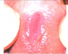 臨沂皮膚病醫(yī)院專家為您介紹非淋的傳染方式有哪些