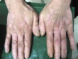 白癜風(fēng)治愈要多少錢