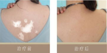 王女士的背部白癜風治好了