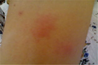 哪幾種是蕁麻疹常見病因