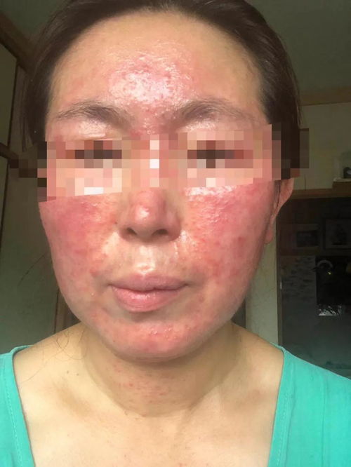 廣州中醫名醫皮膚病研究院 激素依賴性皮炎,除了停用激素,還要怎么辦