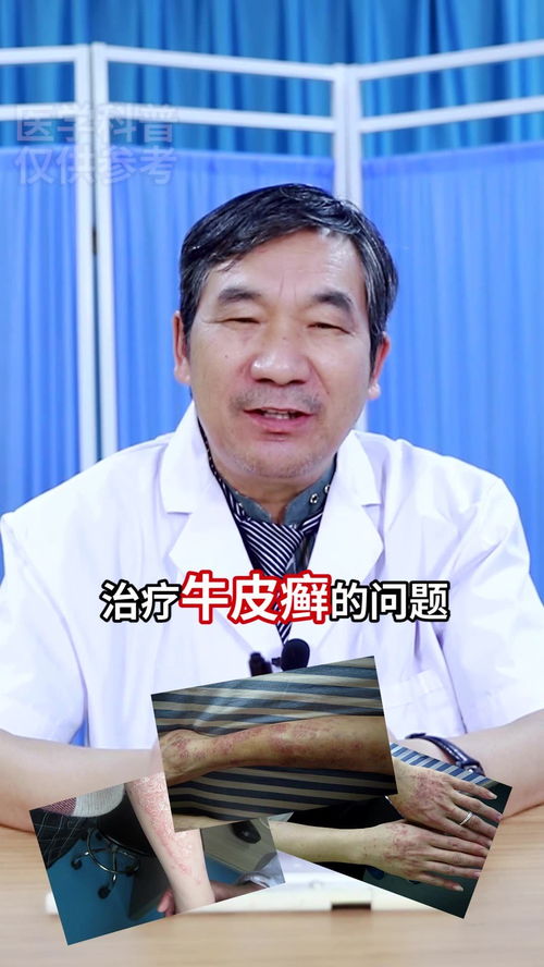 濰坊皮膚病銀康研究院王尚和 30秒講清銀屑病這種針怎么打