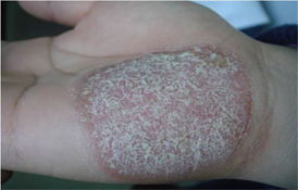 大蒜能治牛皮癬嗎