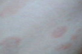 過敏性皮炎要怎么治療