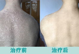 山東煙臺市皮膚病治療最好醫院