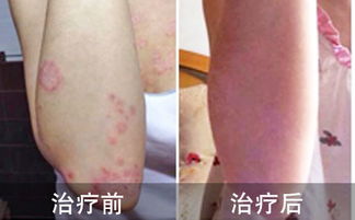 治好牛皮癬,丟掉尷尬