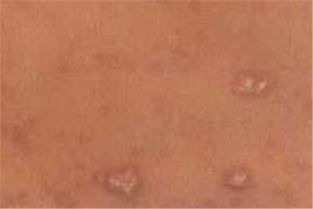 日照過敏皮炎的誘因有哪些