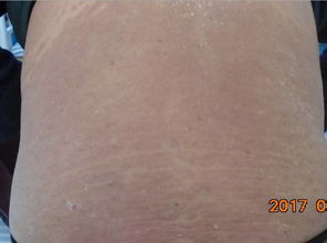 濰坊小伙告別銀屑病,重揚 生命風帆