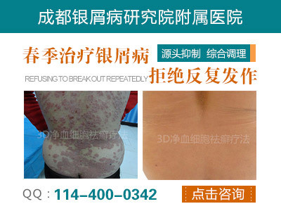 彭州市人民醫(yī)院銀屑病專科_健康頻道