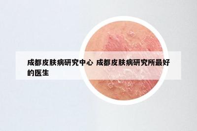 成都皮膚病研究中心 成都皮膚病研究所最好的醫(yī)生