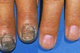 蒙陰縣人民醫(yī)院 灰指甲治療