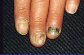 如何讓丑陋至極的灰指甲還出原型