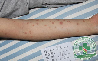 濰坊東方銀屑病研究院分享如何治療銀屑病有效果