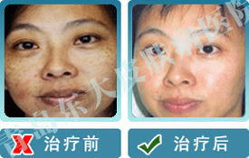 何種因素可以導致蕁麻疹的發病