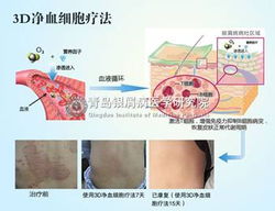 青島治療銀屑病醫院哪家好