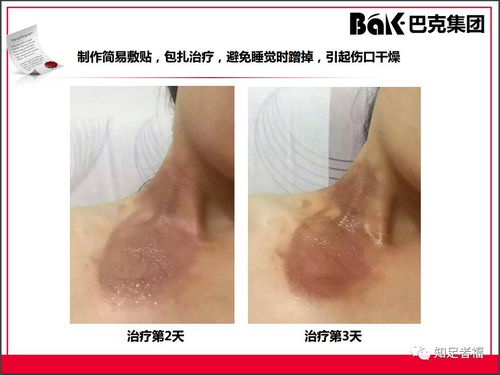 一切皮膚病及外傷的克星,傳統文化義工的事業 巴克產品介紹