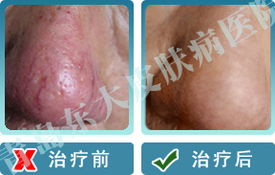 酒槽鼻患者秋季應該怎么護理