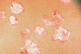 治療牛皮癬的好方法