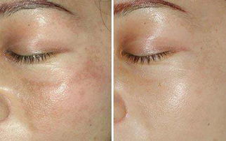 激光祛斑還你潔白無瑕的臉蛋