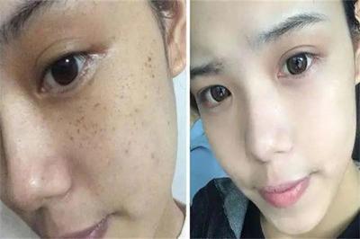 ### 鑫妍國際祛斑祛痘加盟要多少錢?揭秘低成本高回報的創業秘籍!