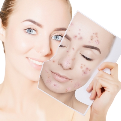 開一家專業祛斑祛痘店多少錢?加盟費多少?總投資25.3萬起,加盟費3.2萬元