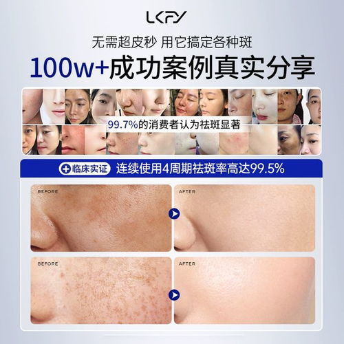 什么牌子淡斑效果最好最安全 專業(yè)淡斑體驗(yàn)分享