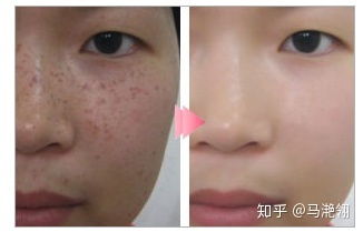 皮秒激光的原理是什么,有哪些注意事項