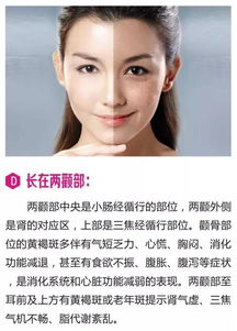 鉑鈺祛斑 黃褐斑是寫在女人臉上的 病