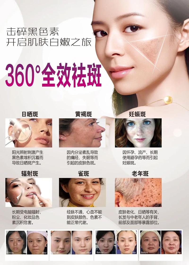 祛斑海報.#美白淡斑 #美容院 #祛斑 #皮膚管理中心 #