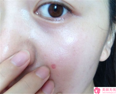 做激光祛斑美容哪兒做得效果好