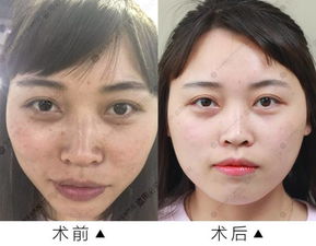 祛斑后出現(xiàn)返黑 燙傷 永久性疤痕等后遺癥 都是因?yàn)槟阌缅e(cuò)了它